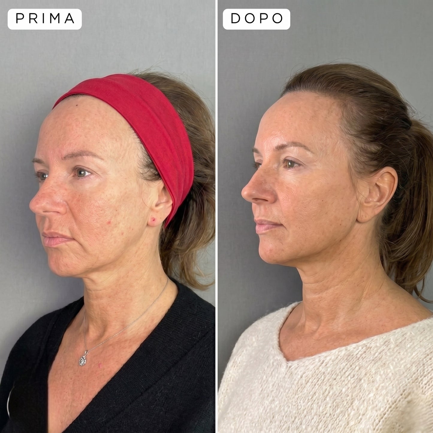 Maschera Viso LED a 7 colori per una pelle senza imperfezioni in poche settimane.